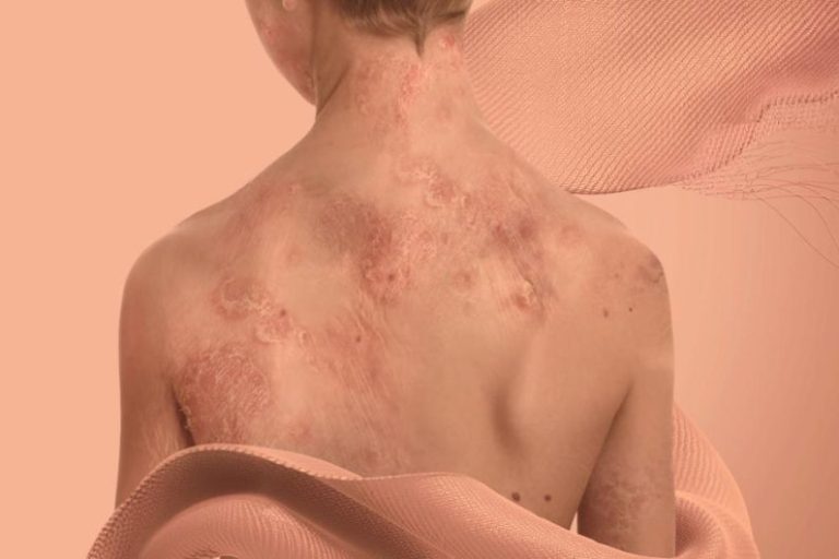 Movistar Colombia transforma sus redes para proteger a los niños con “piel de mariposa”